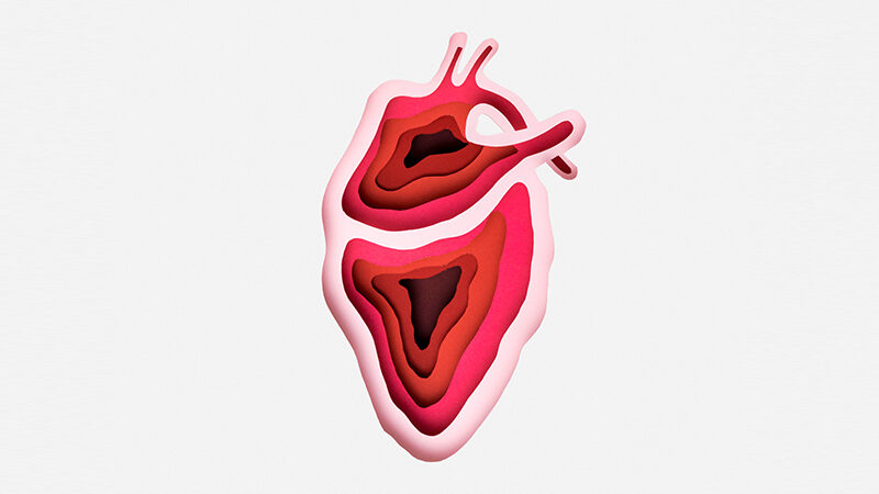 Hypokinesis Heart