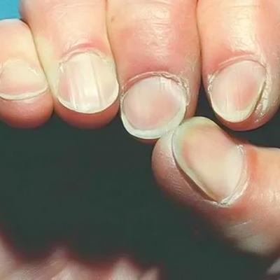 Spoon Shaped Nails