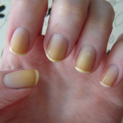 Yellowish and Pale Nails