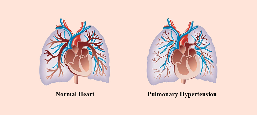 Normal Heart and Pulmonary Hypertension