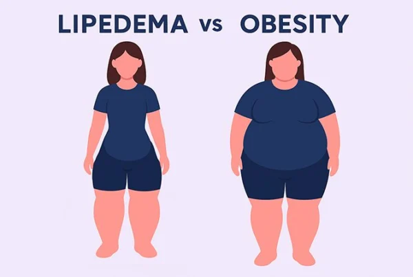 Lipedema vs Obesity
