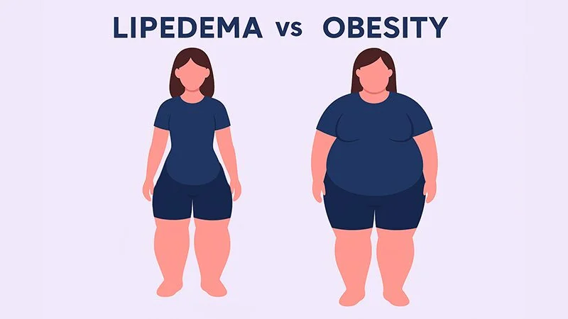 Lipedema vs Obesity
