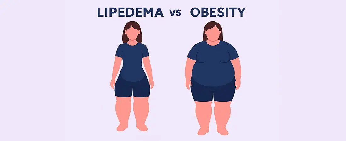 Lipedema vs Obesity