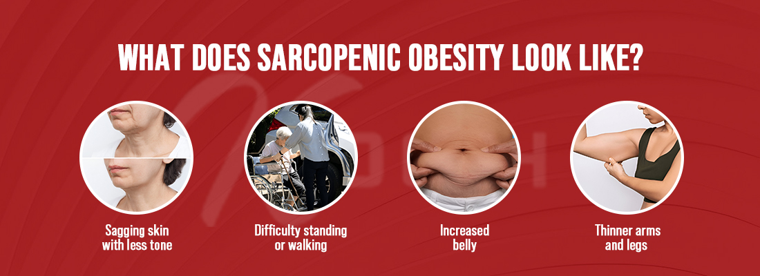 What does Sarcopenic Obesity Look Like