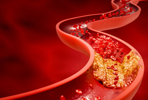 Portal Hypertension
