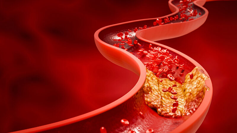 Portal Hypertension