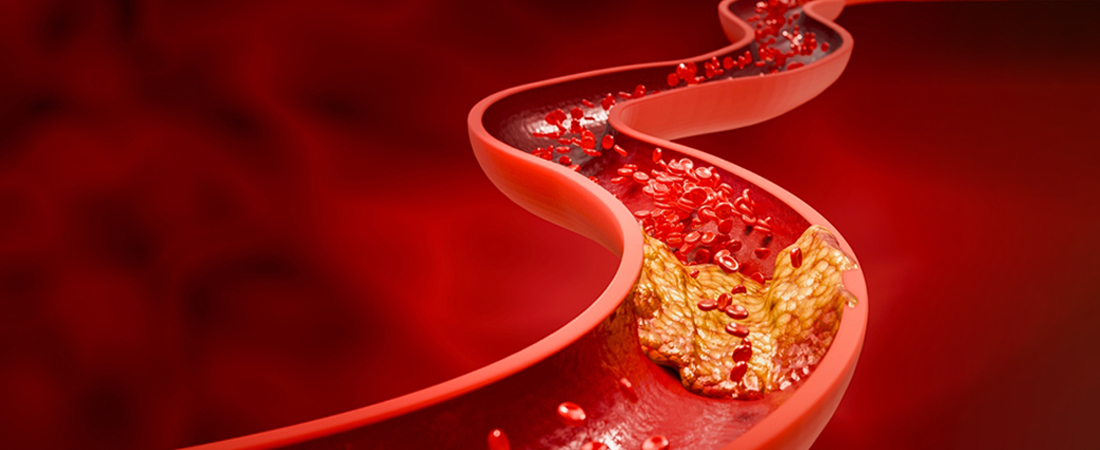 Portal Hypertension
