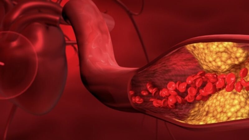Renovascular Hypertension