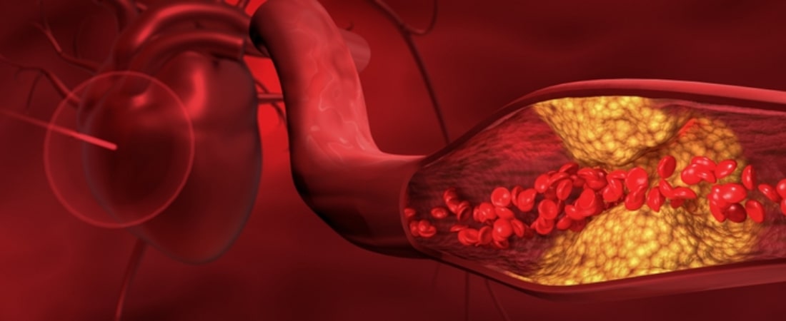 Renovascular Hypertension